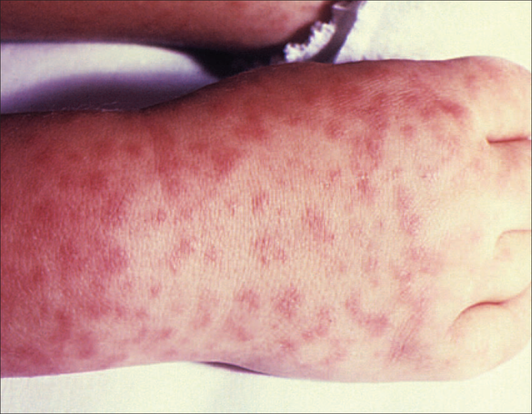 Rashes and Fever in Children Sorting Out the Potentially Dangerous